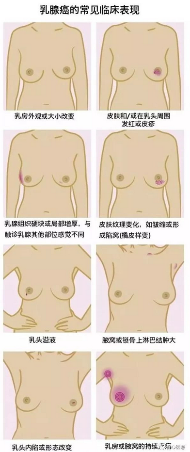 乳腺癌發(fā)生轉(zhuǎn)移了，手術(shù)還有意義嗎？